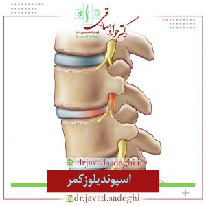 اسپوندیلوز کمر