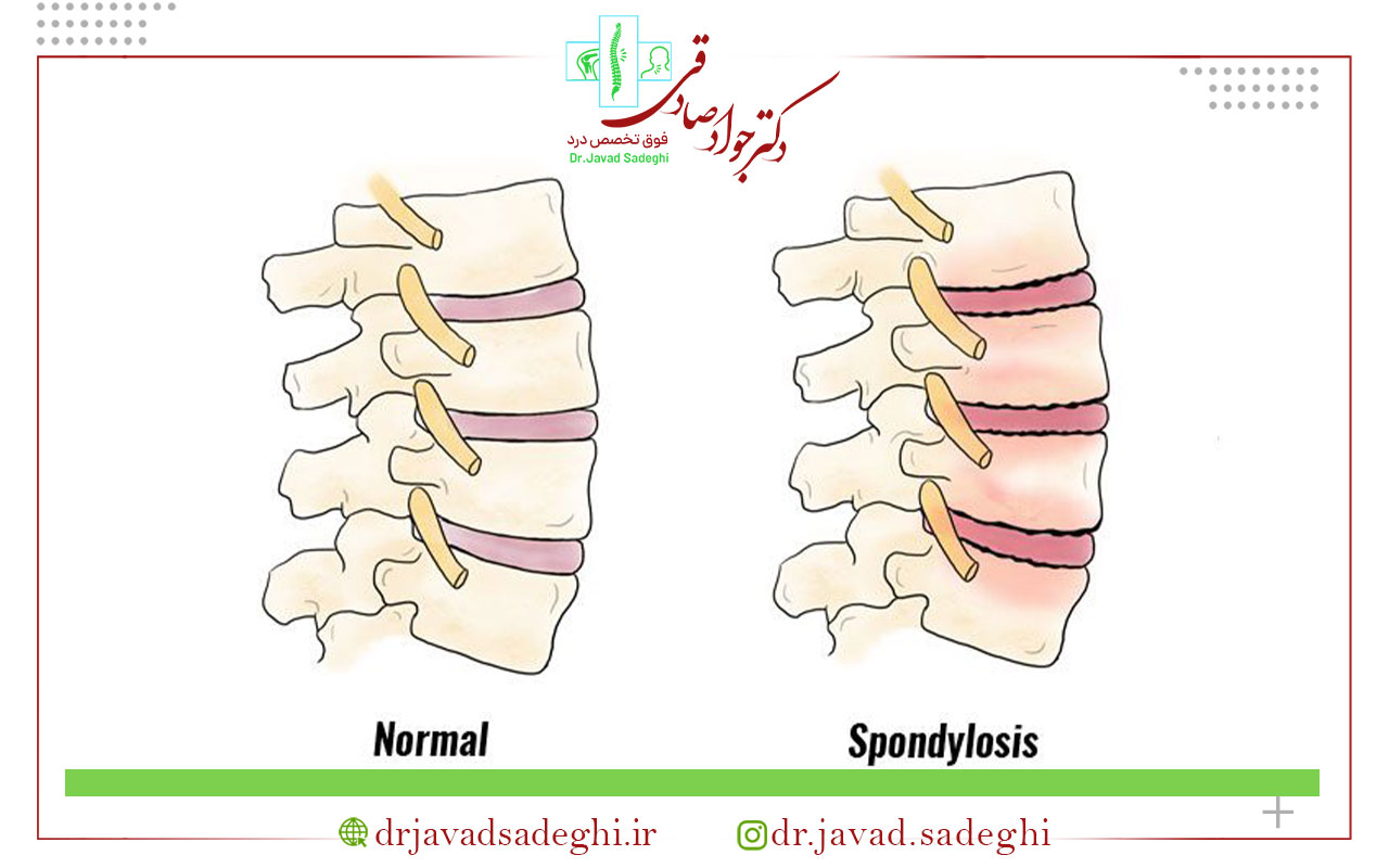 آرتروز ستون فقرات چگونه درمان میشود؟