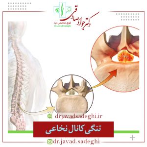 تنگی کانال نخاعی چیست؟