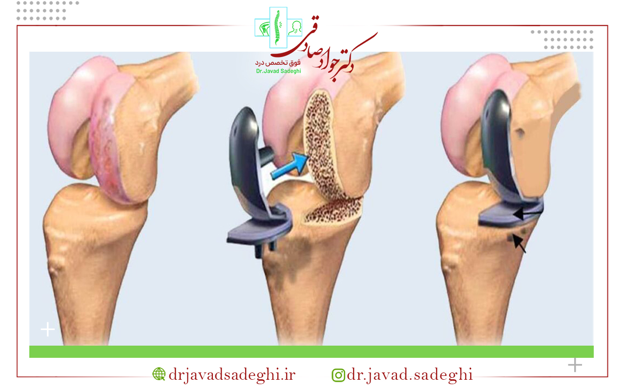نحوه انجام جراحی تعویض مفصل زانو